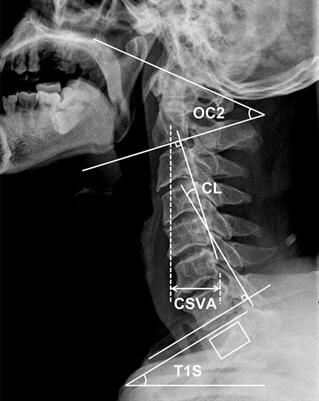 The discrepancy between preoperative cervical sagittal vertical axis and T1 slope predisposes inferior clinical outcomes in patients with cervical spondylotic myelopathy after cervical laminoplasty